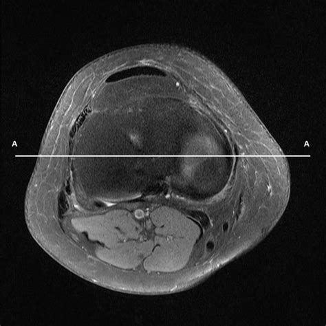 Mr Pd Coronal Image Of Central Tibial Plateau Used For The Measurement