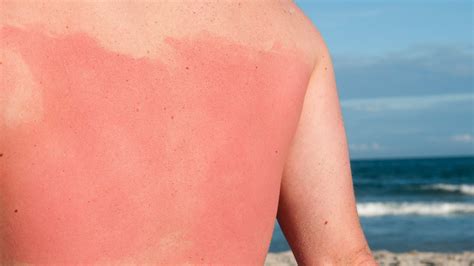 man s sunburn is going viral reminds us the importance of sunscreen allure best cream for
