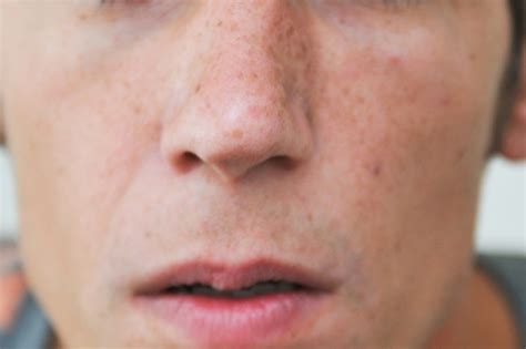 How To Reduce Redness Around Nose Livestrongcom