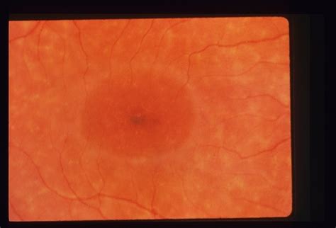 Fundus Flavimaculata Stargardts Retina Image Bank