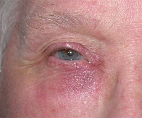 Lid Lump Stye Chalazion Carcinoma Eye Surgery Ltd