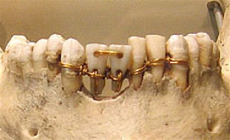 History Of Dental Implants News Dentistry Ancient Egypt Dental