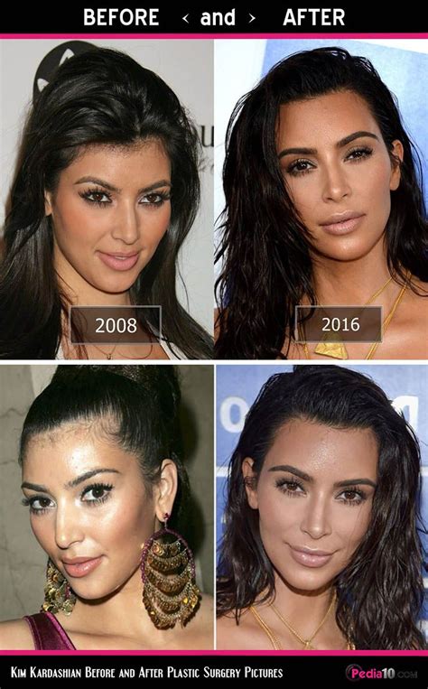 Kim Kardashian Face Pics Plastic Surgery Before And After Photo 5
