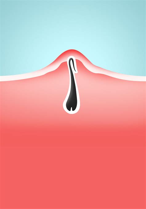 'plucking can remove the entire hair from the follicle if done correctly,' says sofia. This Is How Dermatologists Get Rid of Ingrown Hairs ...