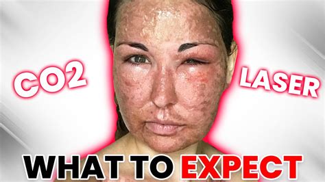 I Survived 3 Fractional Co2 Laser Treatments Youtube