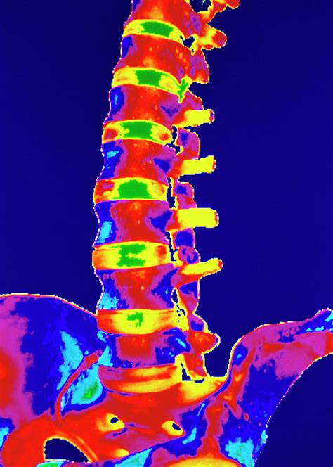 Coloured 3 D Ct Scan Of Lower Spine Photograph By Gjlpscience Photo