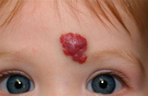 Hemangioma De Piel Síntomas Diagnóstico Tratamiento