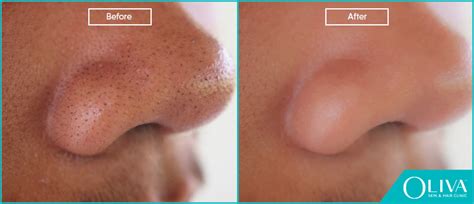 Blackheads On Nose Removal Treatments Cost And Results