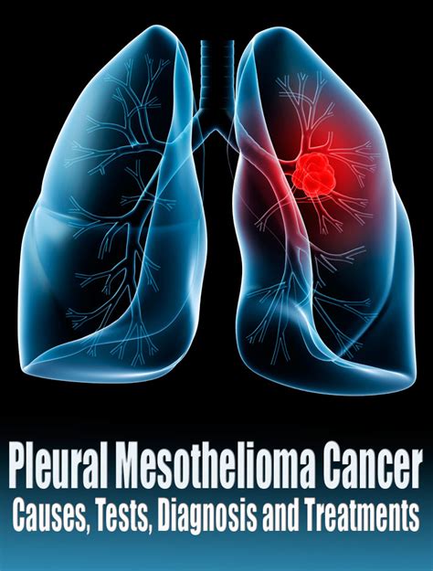 Pleural Mesothelioma Cancer Causes Tests Diagnosis And Treatments