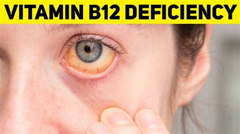 3 Dangerous Sign And Symptoms Of Vitamin B12 Deficiency Youtube