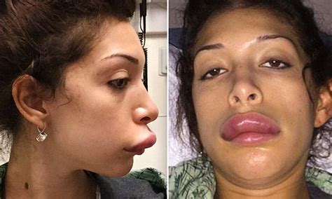 Teen Moms Farrah Abraham In The Er After Her Lip Injections Take A Bad