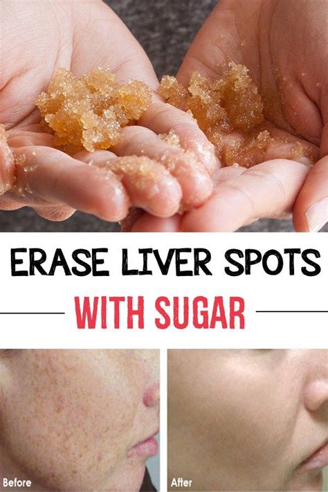 Erase Liver Spots With Sugar Pandora Jewelry More Than 60 Off 35 Usd