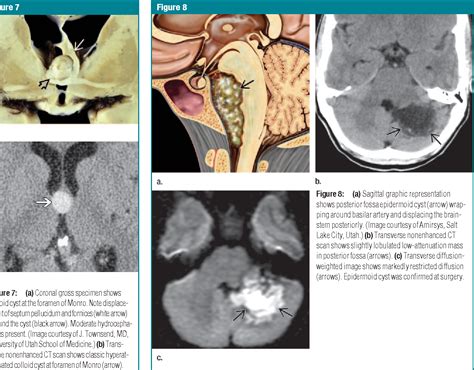 Intracranial Cysts Radiologic Pathologic Correlation And Imaging
