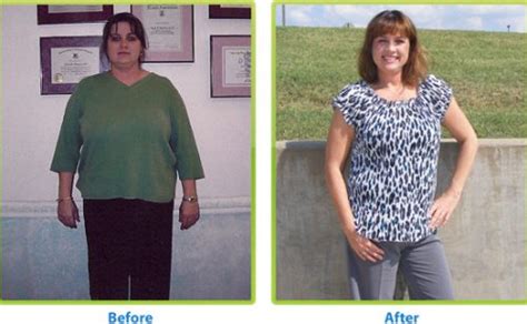 Weight Loss Surgery Should You Go For It Benefits And