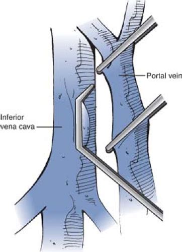 Anatomy Of The Portal System And Experience With Portacaval Shunt