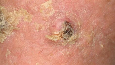 Identifying Skin Cancer 37 Photos You Need To See Stories By Weather