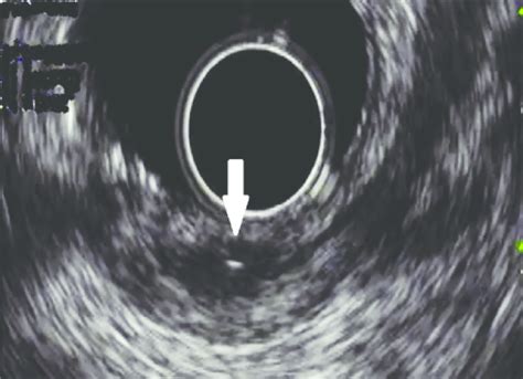 Endoscopic Ultrasound Images Of The Rectal Lesion Showing A