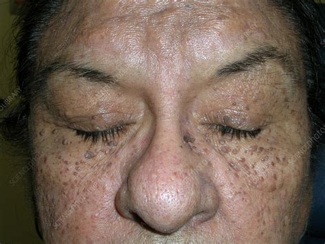 Dermatosis Papulosa Nigra Stock Image C0592782 Science Photo Library