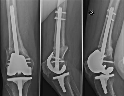 Treatment Of Periprosthetic Supracondylar Fractures After Cr Total Knee