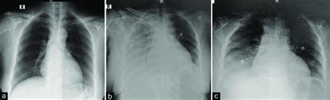 A Preoperative Chest X Ray Pa View For Comparison B The