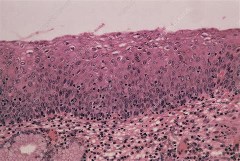 Lm Of Cervical Cells Showing Mild Dysplasia Cin Stock Image M