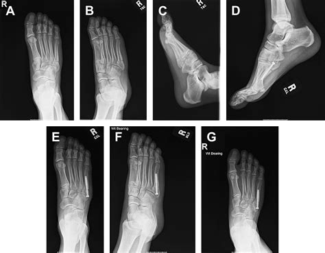 The Complicated Jones Fracture Including Revision And Malalignment Foot And Ankle Clinics