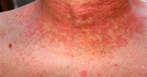 Scarlet Fever Photos Trend Of January