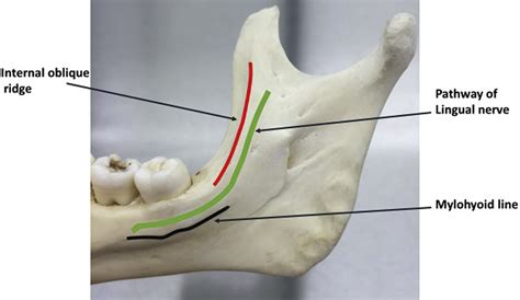 Lingual Nerve Measurements In Cadaveric Dissections Clinical