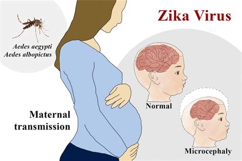 zika virus associated microcephaly when a pregnant woman is infected download scientific