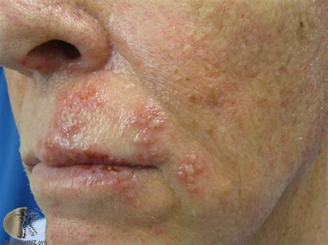 Shingles Rash Mild Early Stages Pictures Ehealthstar