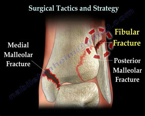 Ankle Fracture Carolina Regional Orthopedics