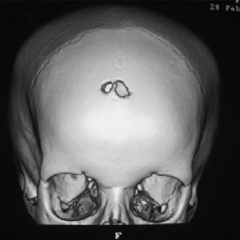 Pdf Spontaneous Regression Of Aneurysmal Bone Cyst Of The Skull Case
