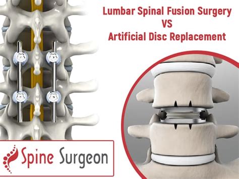 Lumbar Spinal Fusion Surgery Vs Artificial Disc Replacement Spine Surgeon