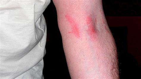 Poison Sumac Rash Pictures And Treatment