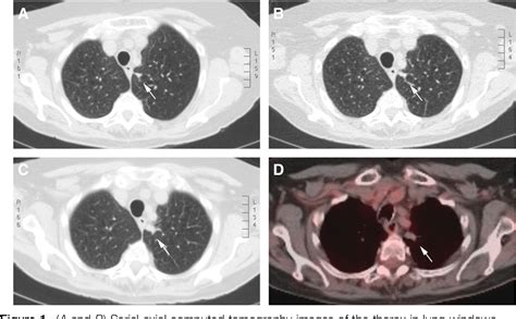Figure 1 From Systemic Amyloidosis Mimicking Lung Cancer Semantic
