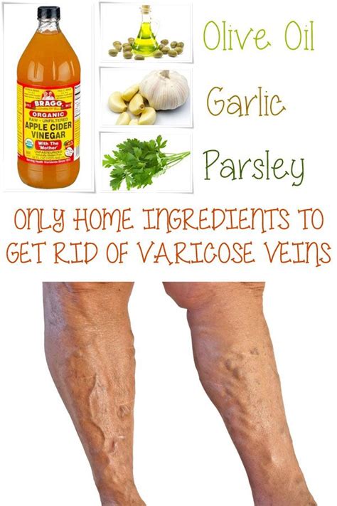 Home Remedies For Varicose Veins Health Varicose Vein Remedy