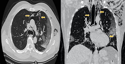 Chest Computed Tomography Ct At Admission Showing Pneumomediastinum