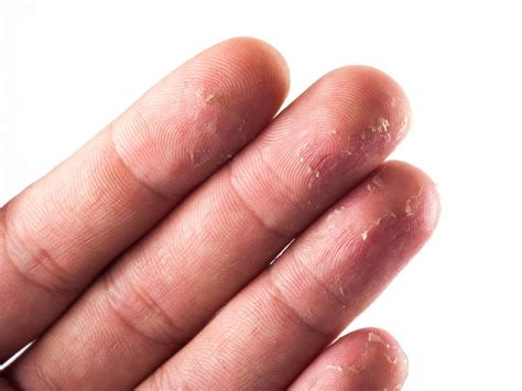 Finger Skin Cracking