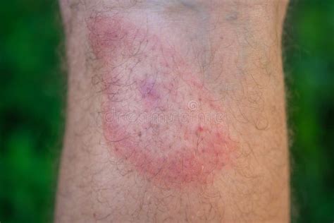 Migrating Erythema After A Tick Bite On A Man`s Leg Stock Photo
