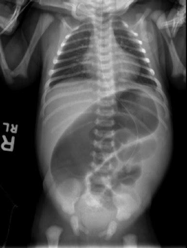 Abdominal X Ray Demonstrated A Large Stomach Bubble With Dilated Loops