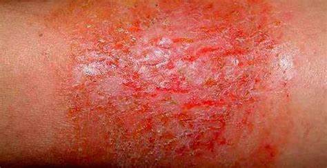 Дерматит симптомы диета Дерматит: причины, симптомы, лечение, виды, фото | У Гиппократа Дерматит: причины, симптомы, лечение, виды, фото | У Гиппократа Дерматит симптомы диета