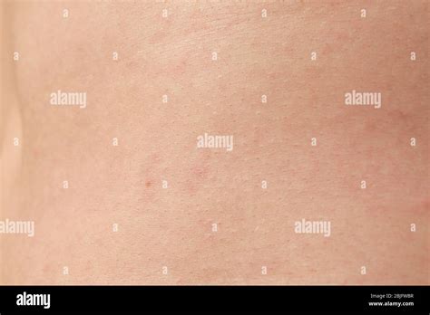 Human Skin With Pimples Closeup Stock Photo Alamy