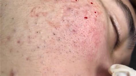 🔥 Pimple Popping 2020 Video Blackheads Full Face Blackheads Removal