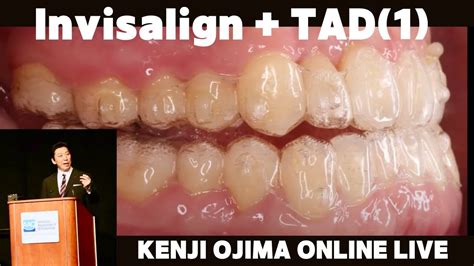 【invisalign Tads①】lower Molar Distalization Case Kenji Ojima Invisalign Live Youtube