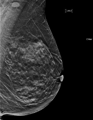 Fox Chase Researchers Examine Benefits Of Breast Imaging With Advanced