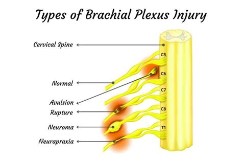 Brachial Plexus Injury And Its Complications A Must Read