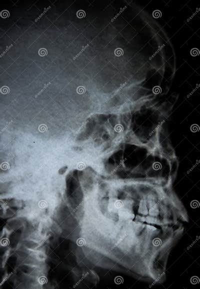 Film X Ray Skull Lateral Stock Image Image Of Skull 91043051