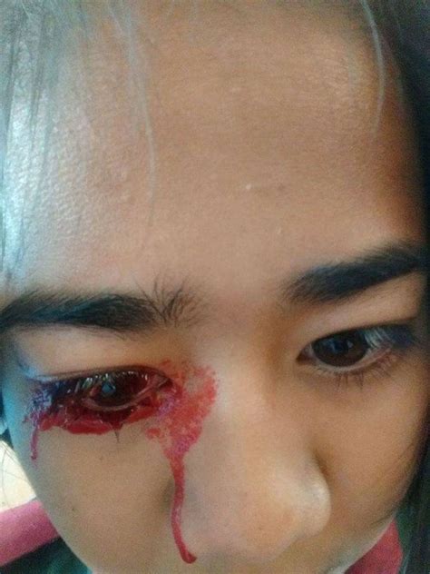 Girl Bleeds From Her Eyes Nose And Ears Due To Rare Condition That