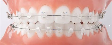 brackets autoligado grupo odontologico dents