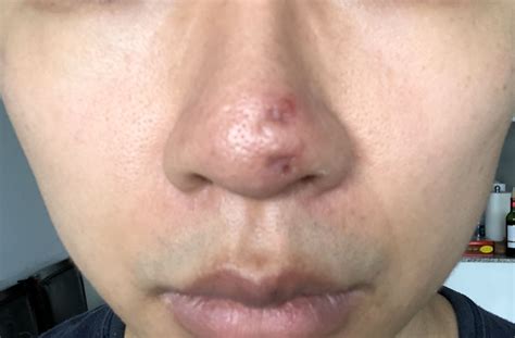 Deep Acne Scars On Nose Scar Treatments Forum